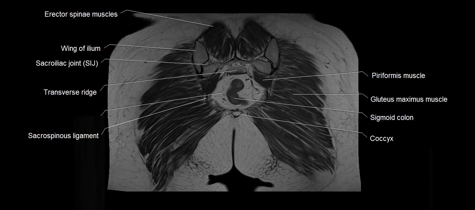 MRI 3T pelvis coronal cross section anatomy image 25.webp